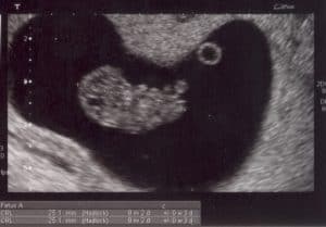 vaginale echo embryo zwanger 9 weken