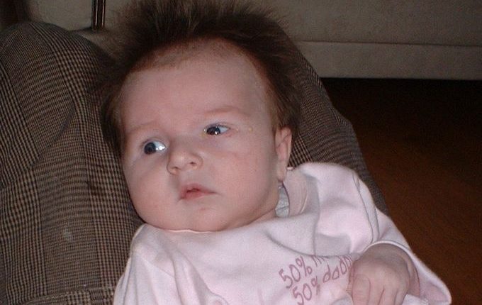 ontstoken "snot"oog bij baby